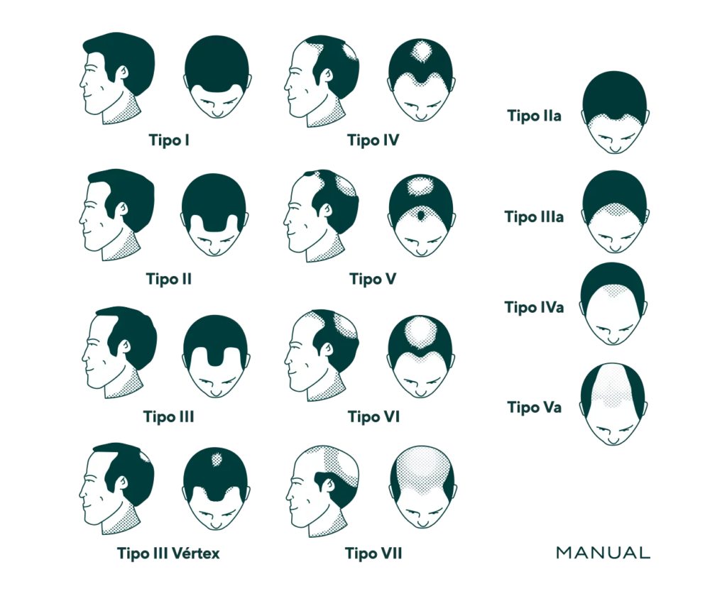 Imagem mostra todos os tipos de queda de cabelo em homens, sendo 7 estes tipos.